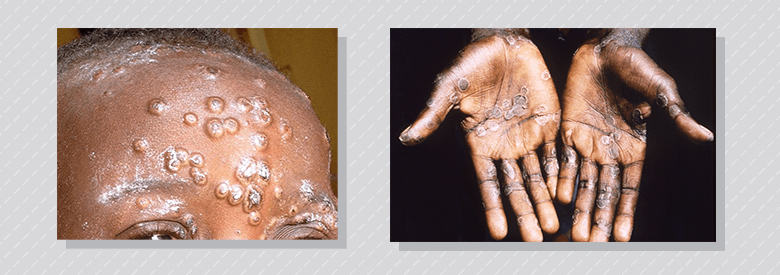 Pustules ombiliquées sur le front, certaines étant croûteuses (à gauche). Mains présentant des vésicules érodées au même stade de guérison chez une personne en période de récupération (à droite).