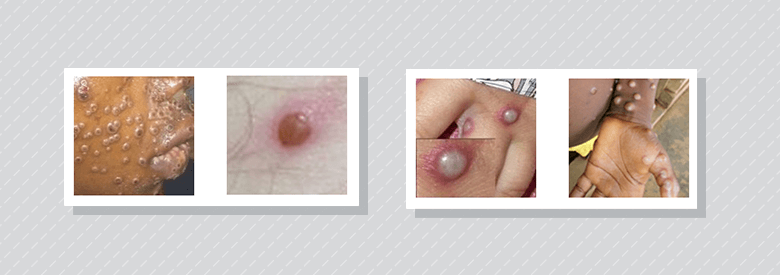 Characteristics of monkeypox skin findings: Umbilicated pustules on the face and lips, some with central crusting (far left); vesicopustule with erythematous base (second from left); pustules with erythematous base (second from right); pustules on the anterior wrist, palm and abdomen (far right).